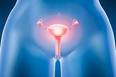 Estudo traz nova alternativa de tratamento para o câncer de ovário